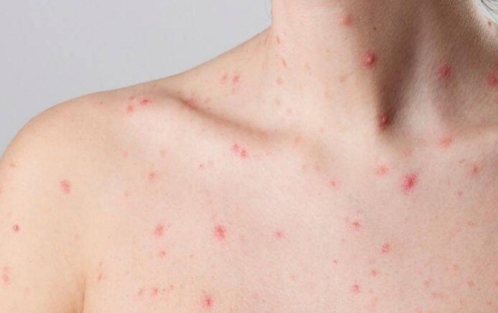 Reportan cinco casos de viruela del mono en Chihuahua