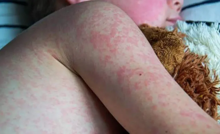 Confirman tres casos mas de sarampión en El Paso, Texas